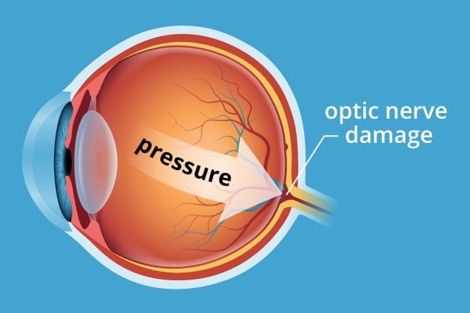 Glaucoma: Everything You Need to Know